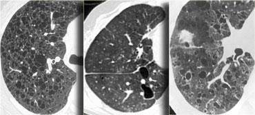 Lymphangiomyomatosis, LIP and Langerhans cell histiocytosis