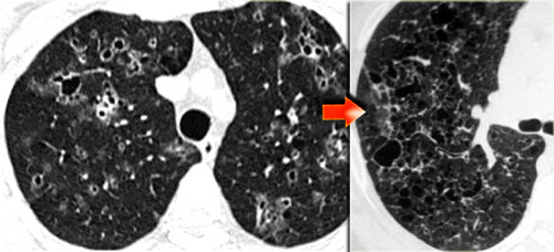 Late stage Langerhans' cell histiocytosis. Cysts progress to typical bizarre shaped cysts.