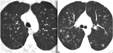 Langerhans cell histiosytosis: early phase and late phase