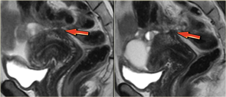 Endometriosis involving the torus uterinus