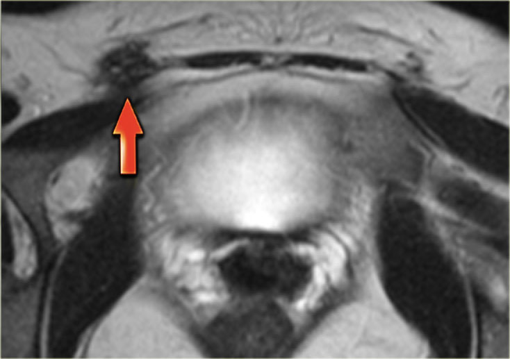 Abdominal wall endometriosis