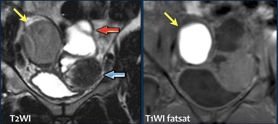 The Radiology Assistant Endometriosis Mri Detection