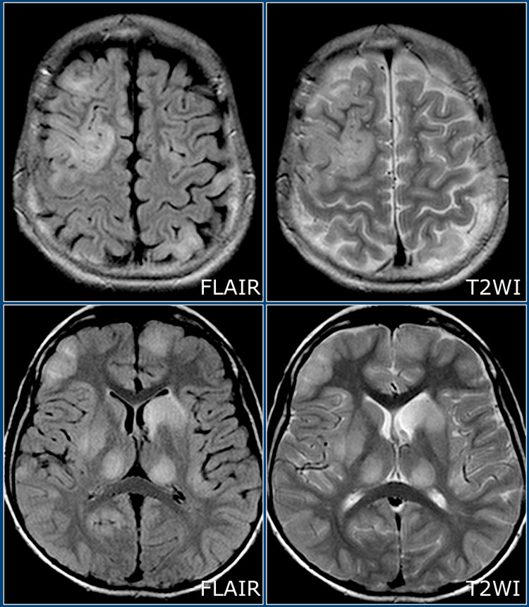 ADEM extensive involvement of the cortical and gray matter - including thalamus.