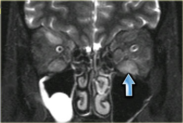 Graves disease