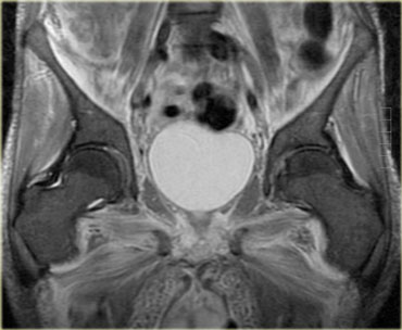 HIV myositis