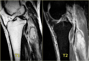 Pyomyositis