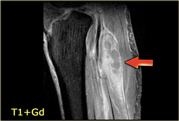 Pyomyositis