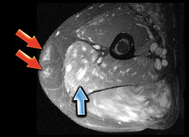 Sarcoidosis