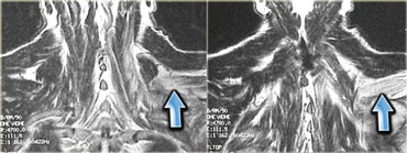 Denervation due to cervical root avulsion