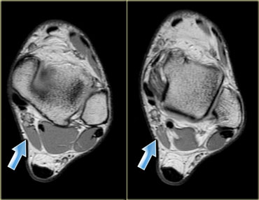 Accessory muscle posterior to the neurovascular  bundle