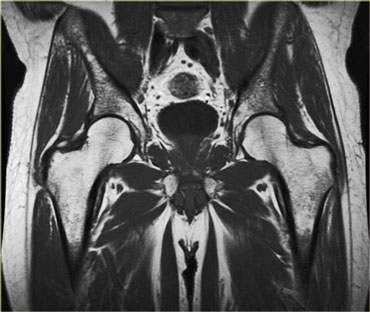 Normal muscle is symmetrical with smooth convex borders, linear branching and feathery fat planes and low signal on all sequences