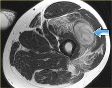 Muscle hematoma and parenchymal hemorrhage