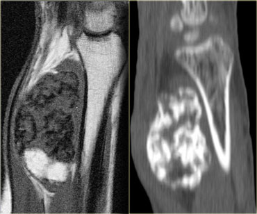 Myositis ossificans