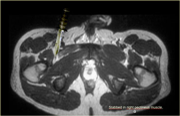 Laceration of right pectineus muscle with atrophy and scar tissue