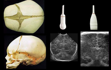 Use both the sector and linear transducer and examine the greater fontanel and if necessary also the lesser and sphenoidal fontanel.