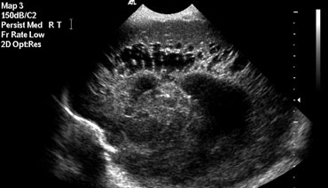 Sagittal image demonstarting extensive PVL grade 3