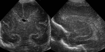 Sagittal and coronal US of a  grade 2 hemorrhage