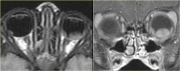 Bilateral retinoblastoma