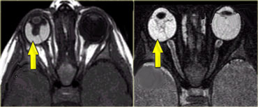 Persistent hyperplastic primary vitrous