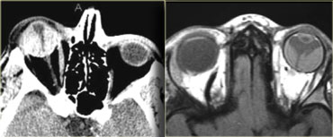 Retinal detachment