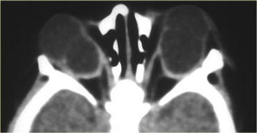 Bilateral colobomas