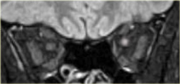 Neuromyelitis optica