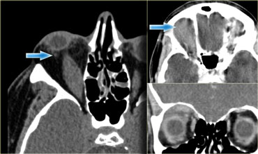 Thyroid eye disease versus pseudotumor