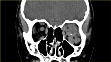 Venous vascular malformation