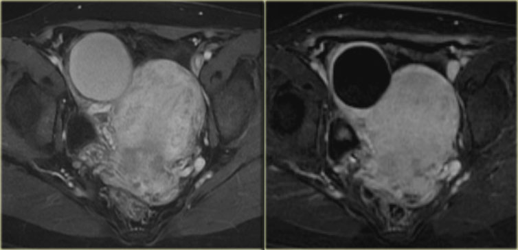 LEFT: Gd-enhanced T1-weighted image with fatsat. RIGHT: Subtraction image.