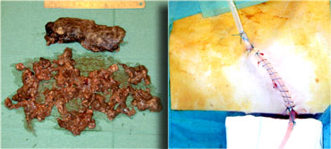 After removal of the necrotic tissue through videoscopic assisted retroperitoneal debridement, catheters are left in place