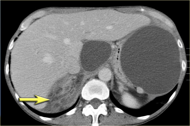 Traumatic pseudocysts