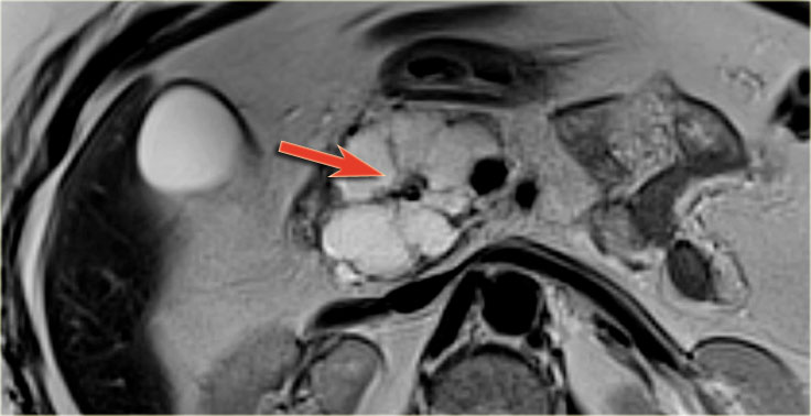 Serous Cystic Neoplasm (SCN)