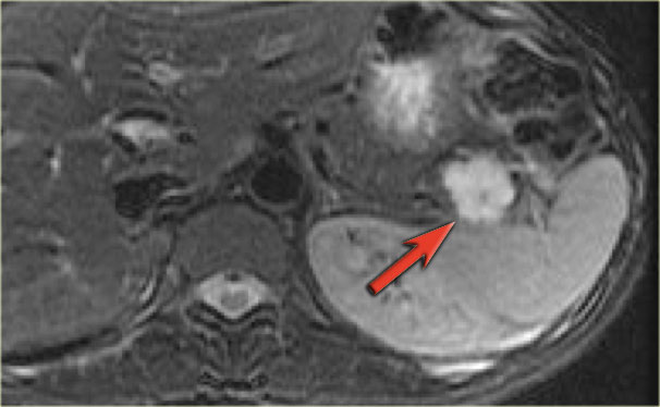 Serous Cystic Neoplasm (SCN)