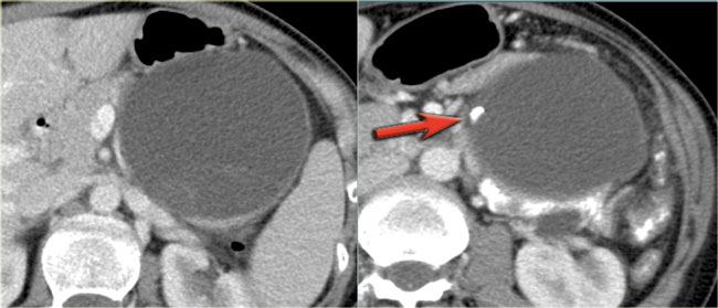 MCN in pancreatic tail in a 32 year-old female ('mother')