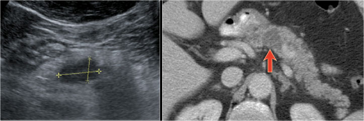 Branch-duct IPMN