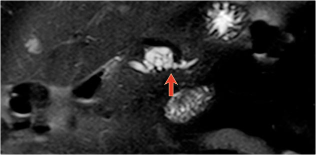 Figure 39. Branch-duct IPMN