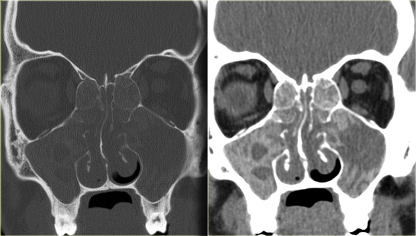 Allergic fungal sinusitis - unenhanced CT