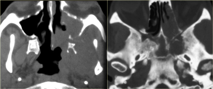 Lymphoma of sphenoid sinus and skull base