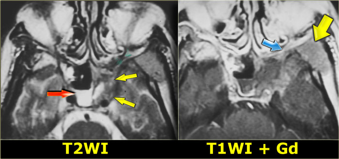 Lymphoma of sphenoid sinus and skull base