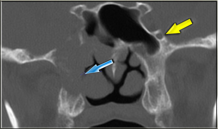 Sinonasal carcinoma