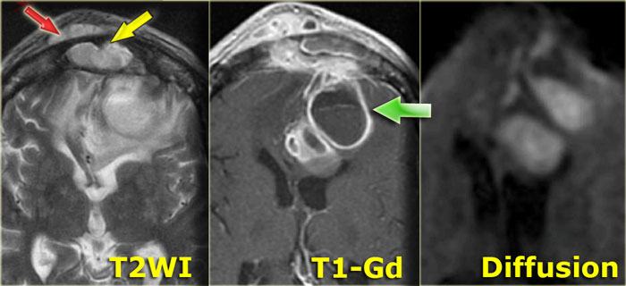 Brain abscess