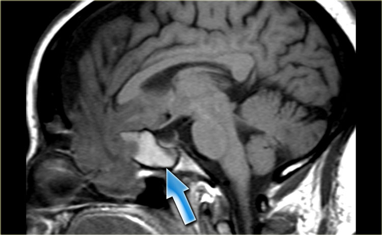 Encephalocele Sag T1WI.