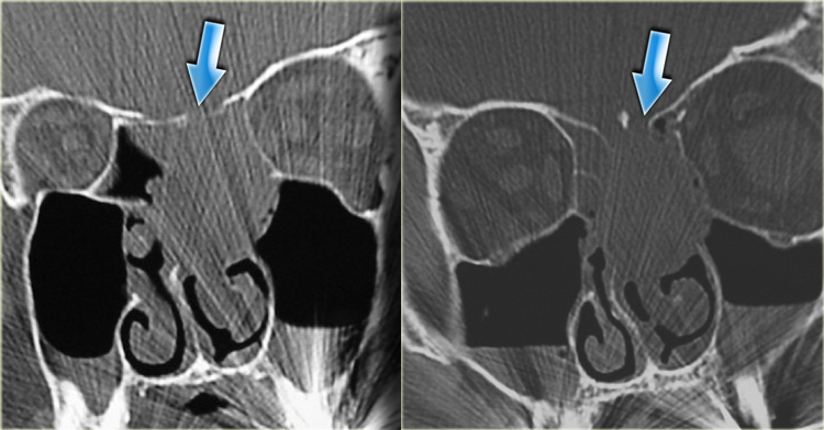 Sinonasal carcinoma