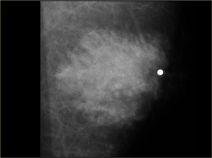 Gynecomastia: nodular glandular pattern.Notice how it blends into the surrounding fat.