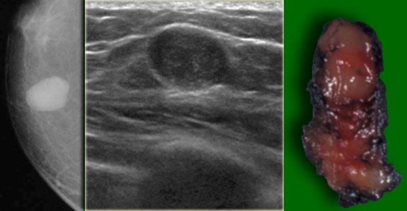 Myofibroblastoma presenting as a circumscribed lobulated mass without calcification