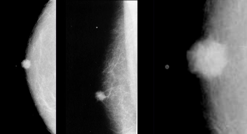 Invasive ductal carcinoma