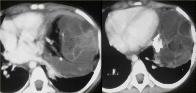 Benign mature teratoma