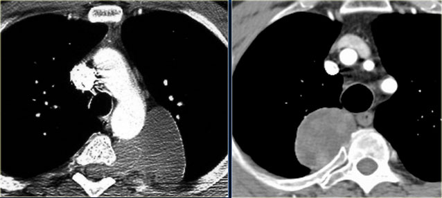 LEFT: Ganglioneuroma, RIGHT: Neurofibroma.