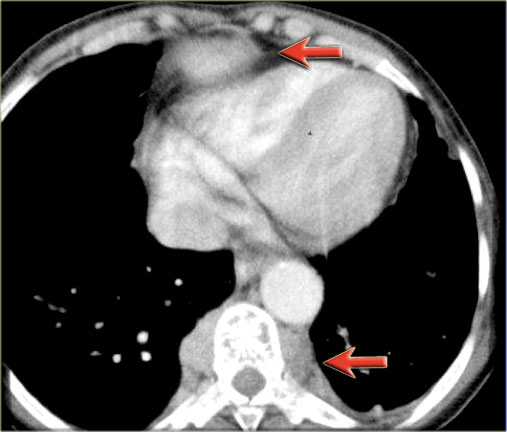 Extramedullary hematopoiesis masses in the paraspinal area and adjacent to the sternum.