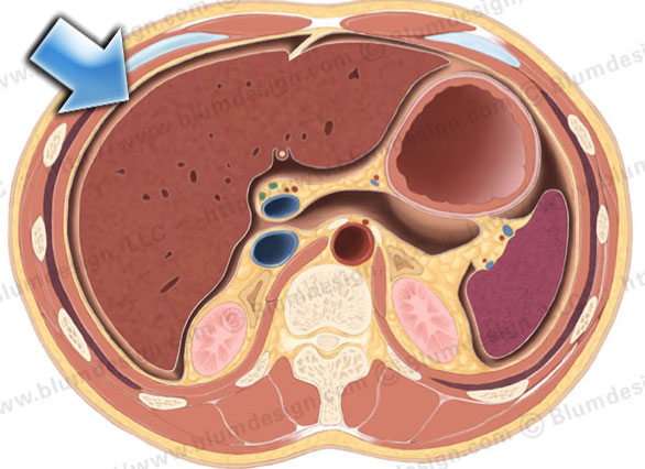 The majority of the peritoneal fluid is cleared at the subphrenic space (arrow) by the submesothelial lymphatics